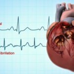 11 Natural Treatments for atrial fibrillation