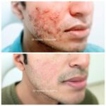 acne scars treatment in Mumbai