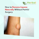 How to Remove Lipoma Naturally Without Painful Surgery